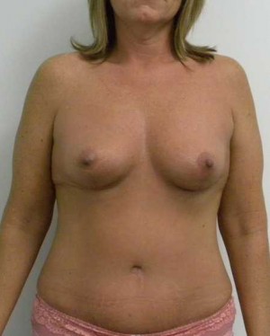 Breast Lift Case 5477 After Photo Breast Lift