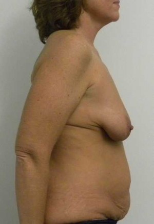 Breast Lift Case 5477 Before Photo Breast Lift