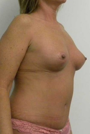 Breast Lift Case 5477 After Photo Breast Lift