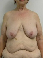 Breast Lift