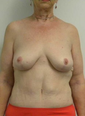 Breast Lift Case 5484 After Photo Breast Lift