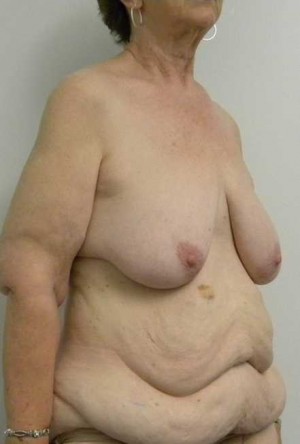 Breast Lift Case 5484 Before Photo Breast Lift