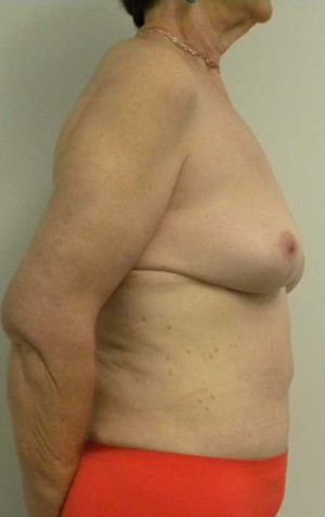 Breast Lift Case 5484 After Photo Breast Lift