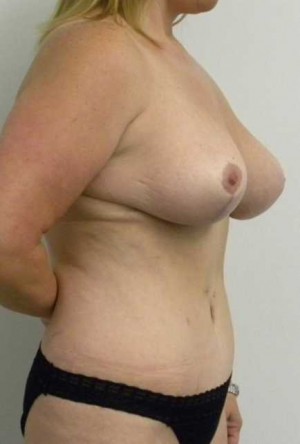 Breast Lift Case 5491 After Photo Breast Lift
