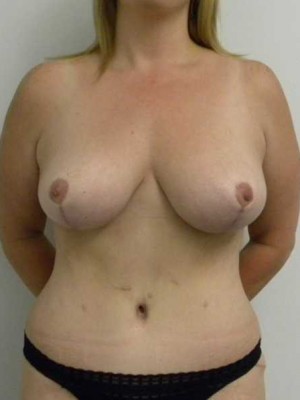 Breast Lift Case 5491 After Photo Breast Lift