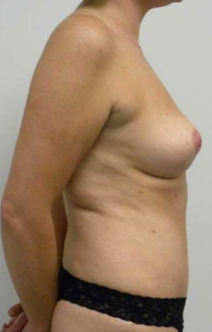 Breast Lift Case 5498 After Photo Breast Lift