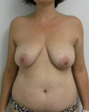 Breast Lift Case 5498 Before Photo Breast Lift