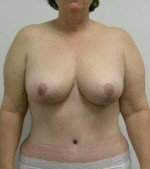 Breast Lift