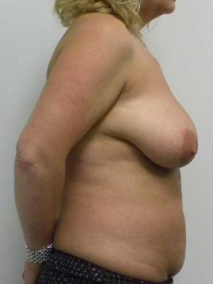 Breast Lift Case 5526 Before Photo Breast Lift