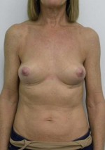 Breast Lift