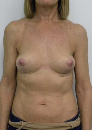 Breast Lift