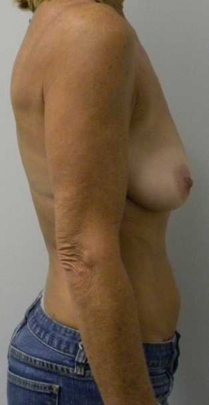 Breast Lift