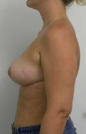 Breast Lift Case 5547 After Photo Breast Lift