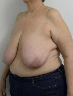 Breast Lift Case 5554 Before Photo Breast Lift