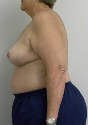 Breast Lift Case 5554 After Photo Breast Lift