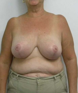 Breast Lift Case 5561 After Photo Breast Lift