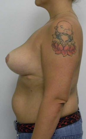Breast Lift Case 5568 After Photo Breast Lift