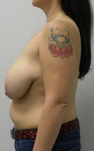 Breast Lift Case 5568 Before Photo Breast Lift