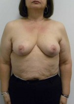 Breast Lift