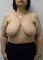 Breast Lift