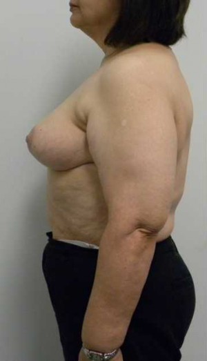 Breast Lift Case 5580 After Photo Breast Lift