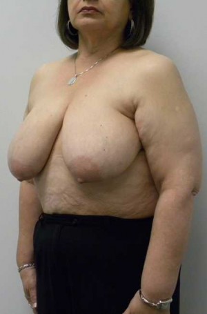 Breast Lift Case 5580 Before Photo Breast Lift