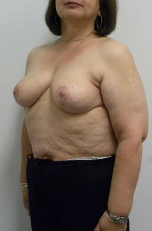 Breast Lift Case 5580 After Photo Breast Lift