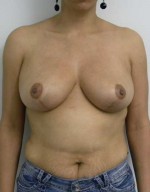 Breast Lift