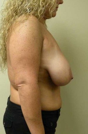 Breast Lift Case 5628 Before Photo Breast Lift