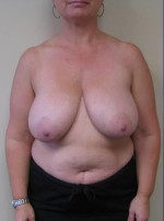 Breast Lift
