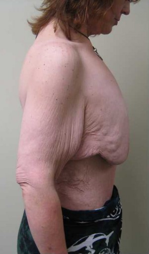 Breast Lift Case 5682 Before Photo Breast Lift