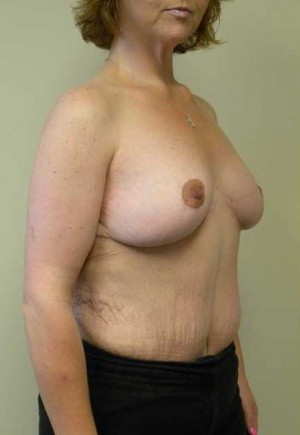 Breast Lift Case 5682 After Photo Breast Lift