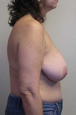 Breast Lift Case 5694 Before Photo Breast Lift