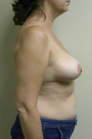 Breast Lift Case 5694 After Photo Breast Lift