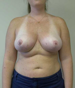 Breast Lift Case 5701 After Photo Breast Lift
