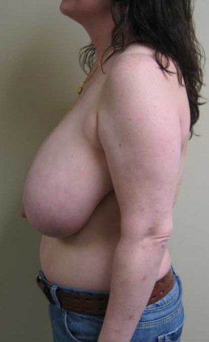 Breast Lift Case 5708 Before Photo Breast Lift