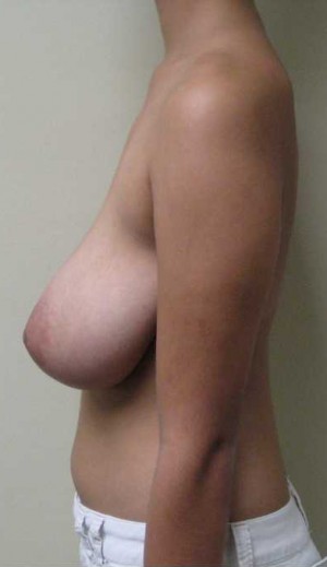 Breast Lift Case 5715 Before Photo Breast Lift