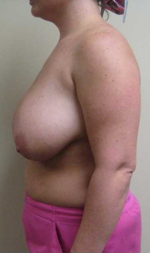 Breast Lift Case 5729 Before Photo Breast Lift