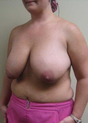 Breast Lift Case 5729 Before Photo Breast Lift