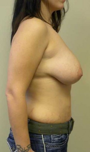 Breast Lift Case 5743 Before Photo Breast Lift