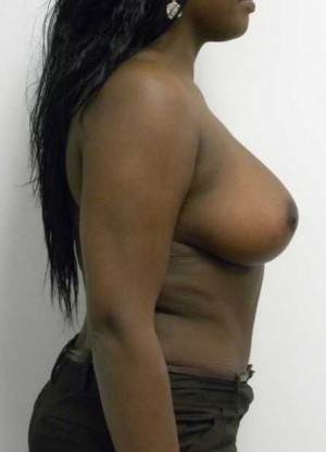Breast Reduction Case 5762 After Photo Breast Reduction