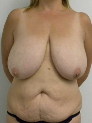 Breast Reduction Case 5769 Before Photo Breast Reduction