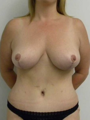 Breast Reduction