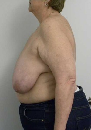 Breast Reduction Case 5783 Before Photo Breast Reduction