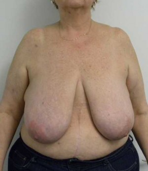 Breast Reduction Case 5783 Before Photo Breast Reduction