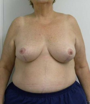 Breast Reduction Case 5783 After Photo Breast Reduction