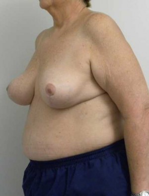 Breast Reduction Case 5783 After Photo Breast Reduction