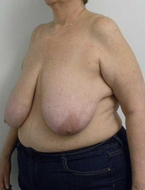 Breast Reduction Case 5783 Before Photo Breast Reduction