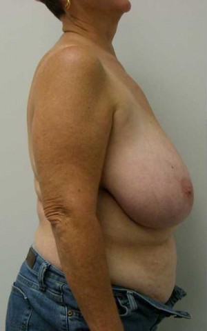 Breast Reduction Case 5790 Before Photo Breast Reduction