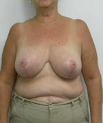 Breast Reduction